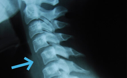 Subluxation